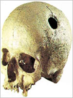 Операции по трепанации черепа у древних инков