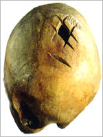 Операции по трепанации черепа у древних инков
